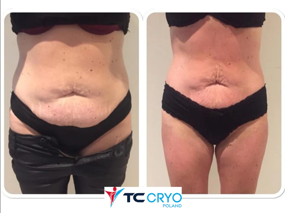 TC CRYO XL - KRIOLIPOLIZA KONTRASTOWA - obrazek 7