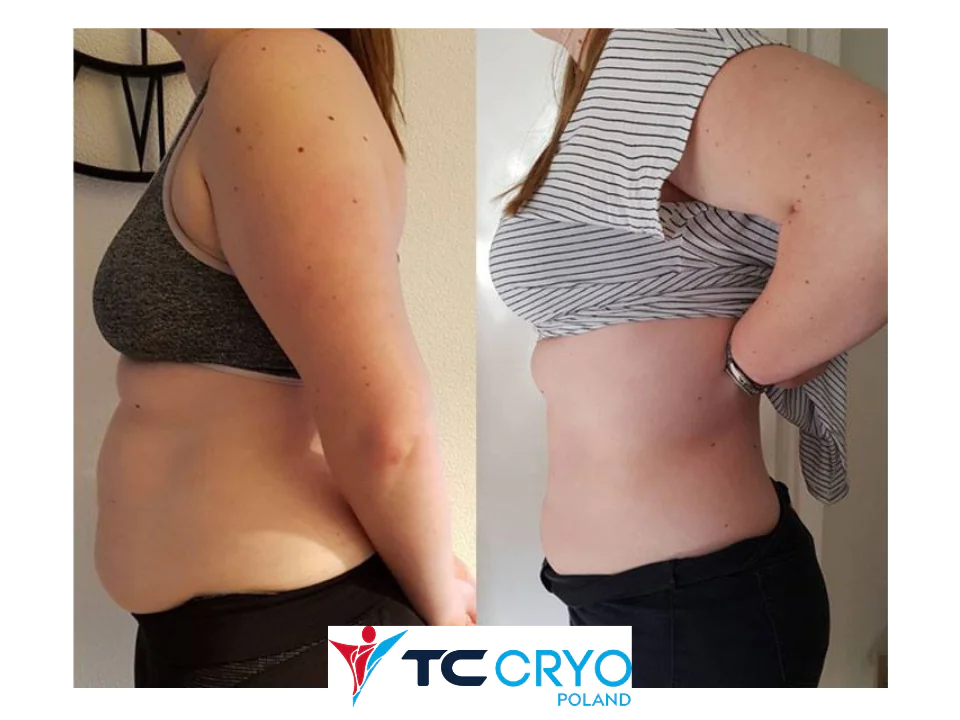 TC CRYO XL - KRIOLIPOLIZA KONTRASTOWA - obrazek 6