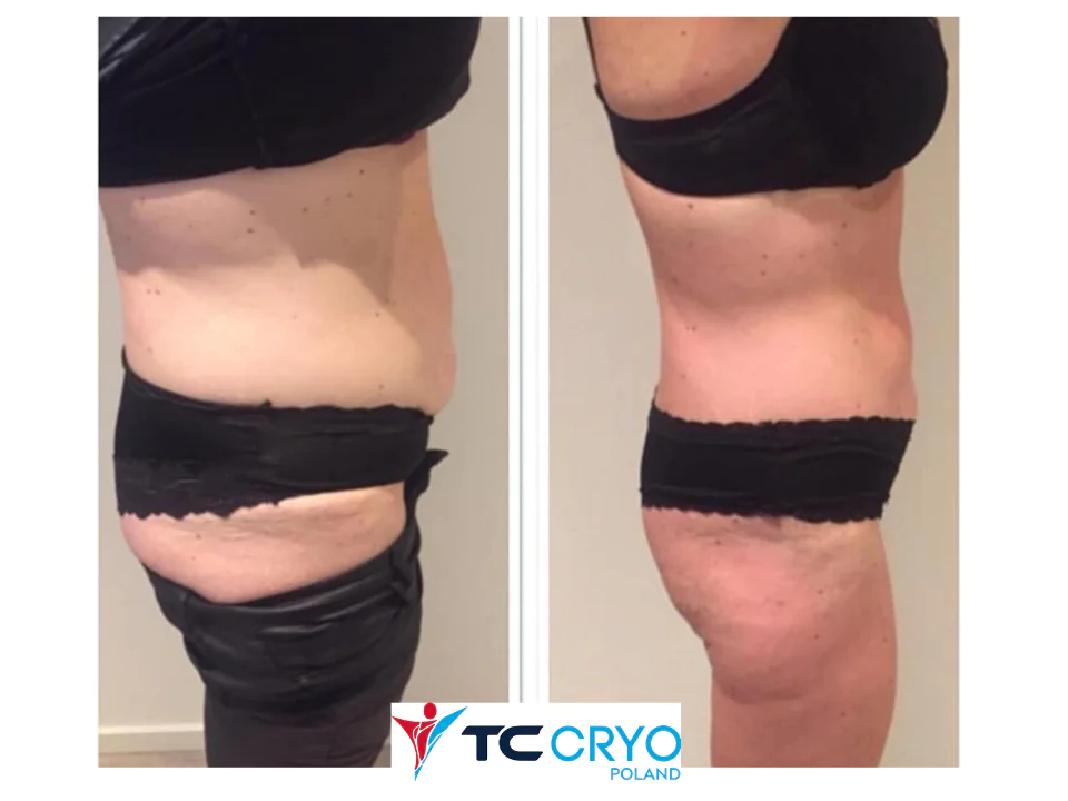 TC CRYO XL - KRIOLIPOLIZA KONTRASTOWA - obrazek 5