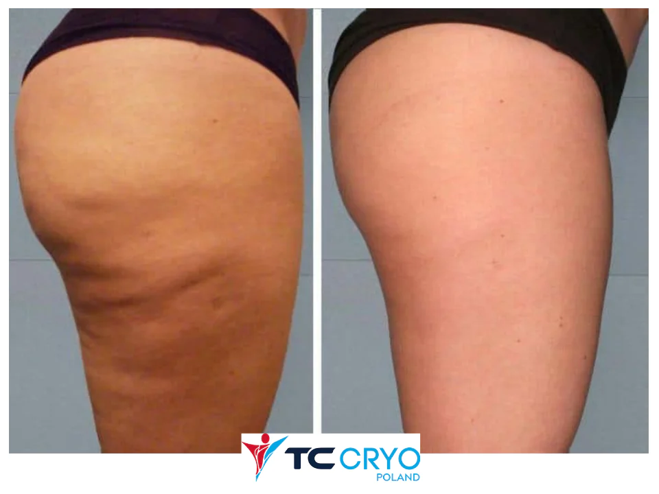 TC CRYO XL - KRIOLIPOLIZA KONTRASTOWA - obrazek 4