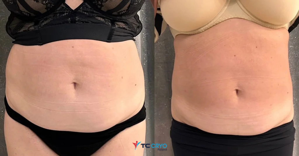 TC CRYO XL - KRIOLIPOLIZA KONTRASTOWA - obrazek 3