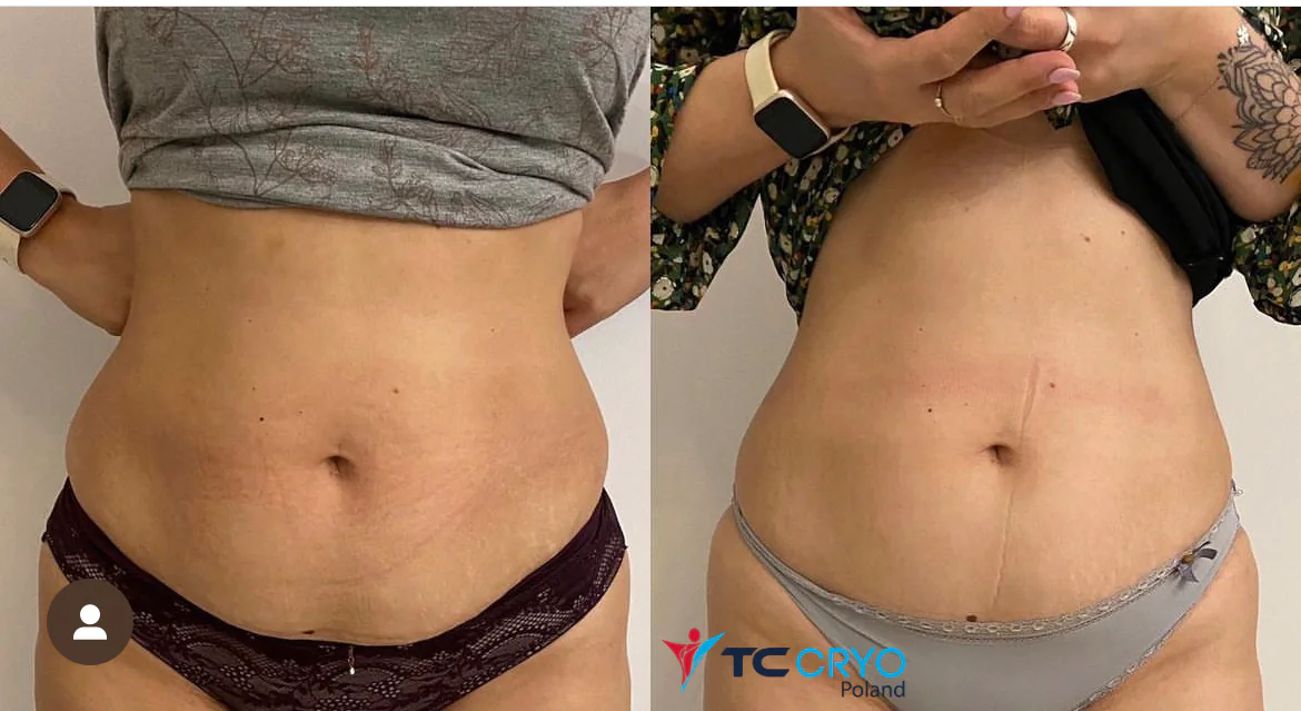 TC CRYO XL - KRIOLIPOLIZA KONTRASTOWA - obrazek 2